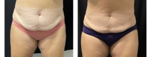 Coolsculpting Treatment Results of Abdomen after 1 Session
