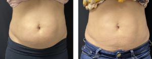 Coolsculpting Results of Abdomen 90 Days from Treatment